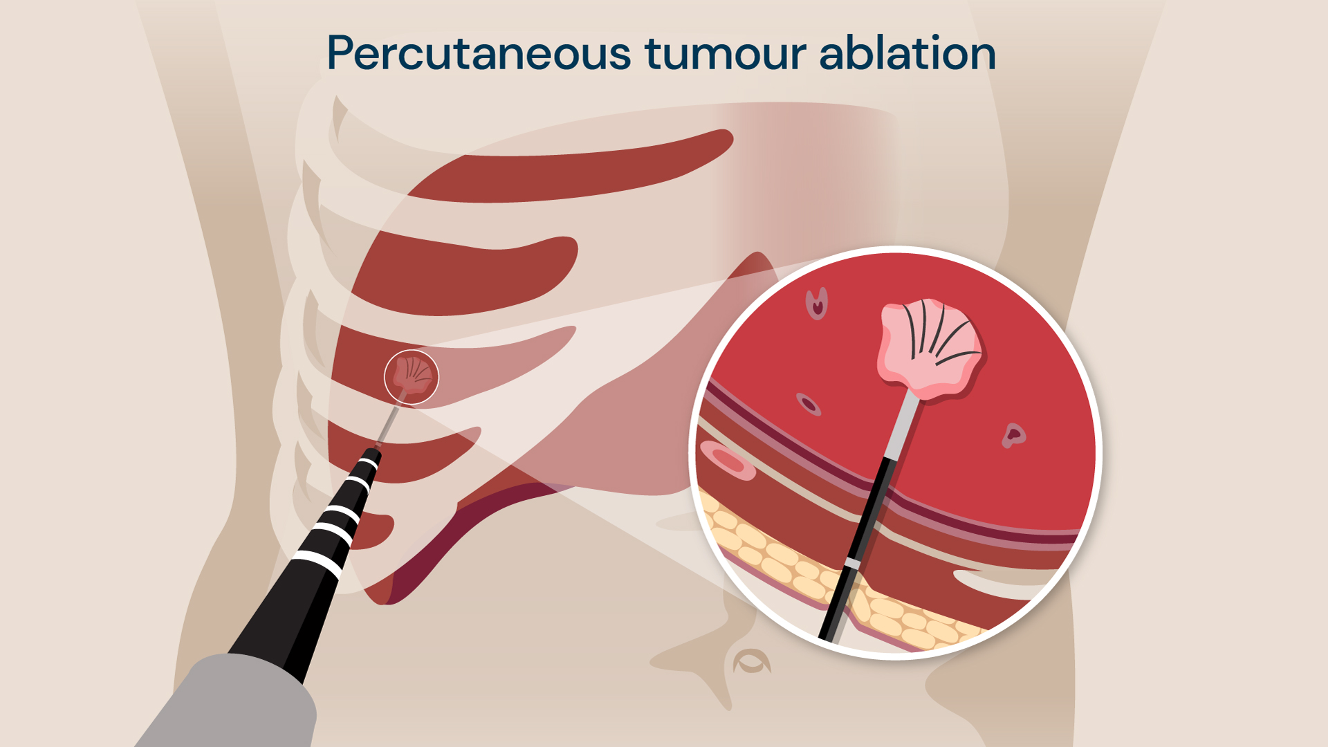 A diagram of a percutaneous tumour ablation procedure.