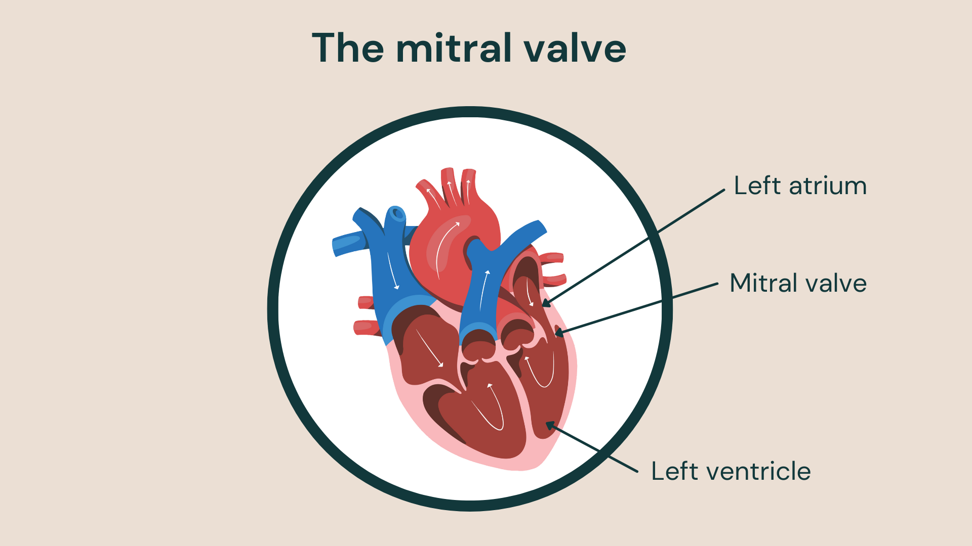 Medical illustration of the heart highlighting the mitral valve between the left atrium and left ventricle.