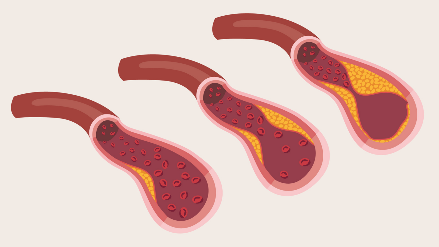 Illustration showing three coronary arteries with increasing fatty plaque build‑up, narrowing the artery and restricting blood flow to the heart