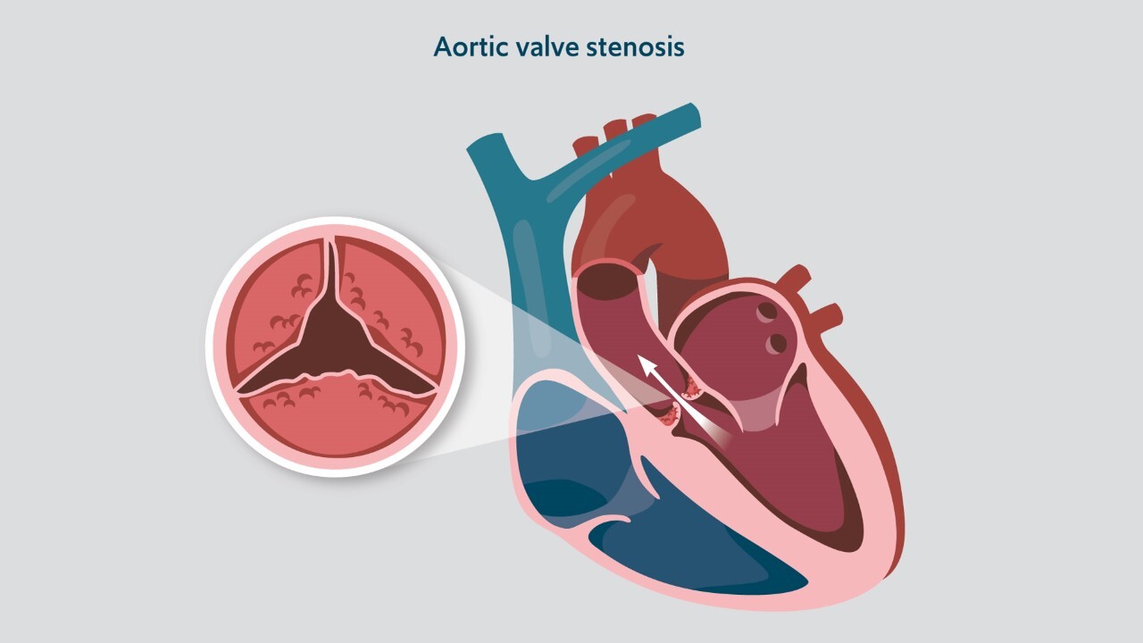 A diagram showing aortic valve stenosis