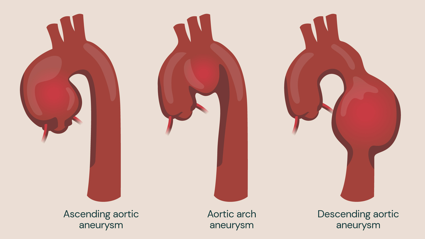 Diagram of the thoracic aorta highlighting aneurysms in the ascending aorta, aortic arch and descending aorta.