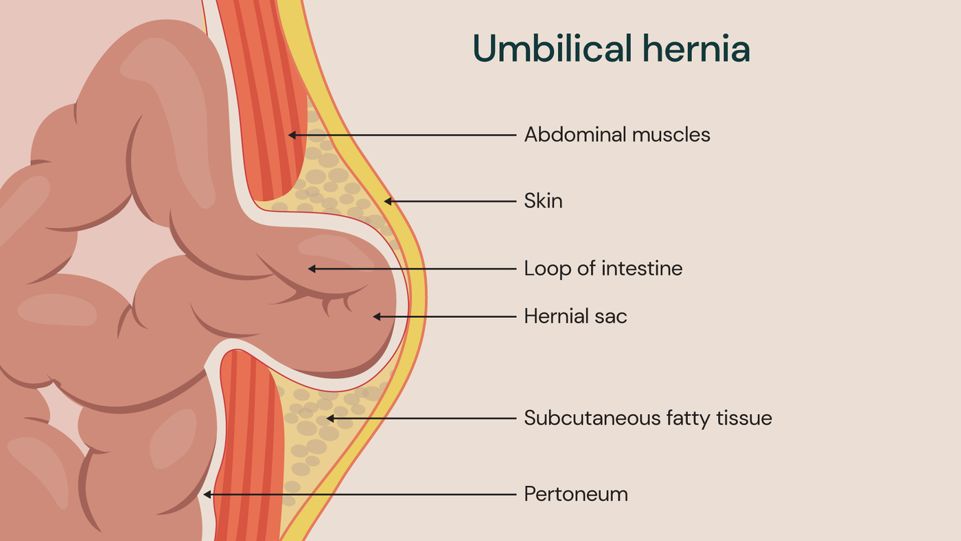 Cross-sectional medical illustration of an umbilical hernia showing a loop of intestine bulging through weakened abdominal muscles near the navel, with labelled layers including skin, hernial sac, subcutaneous fat and peritoneum.
