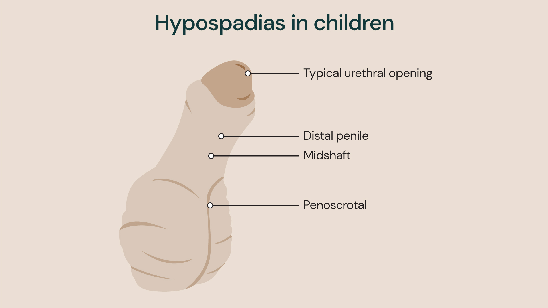 Hypospadias