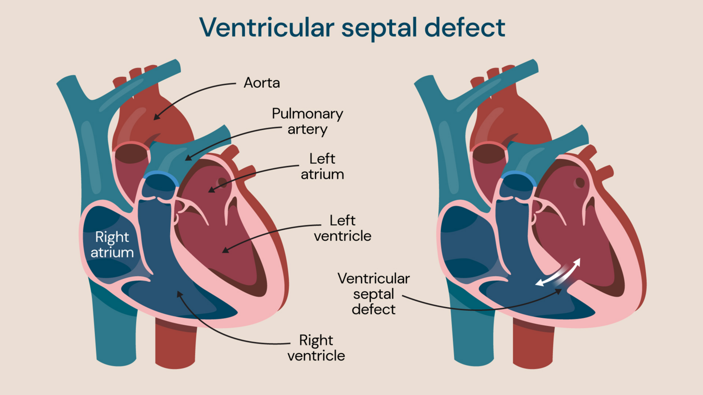 Ventricular septal defect