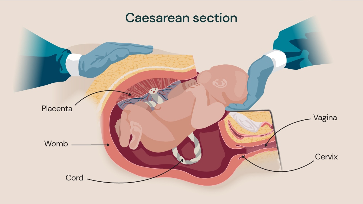 Medical illustration of a caesarean section showing a baby being delivered through an incision in the abdomen and womb, with labelled anatomy including placenta, cord, cervix and vagina