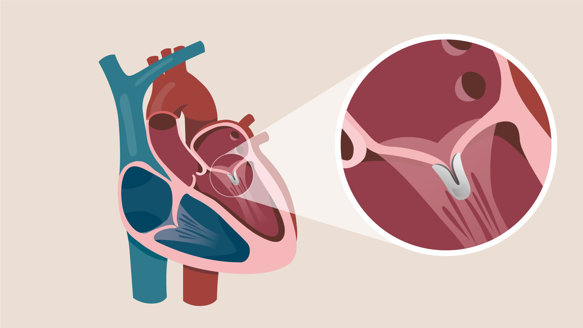 Medical illustration of the heart showing a MitraClip device attached to the mitral valve to reduce mitral regurgitation.