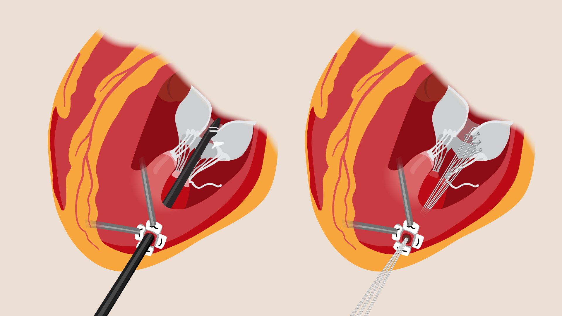 Medical illustration showing the NeoChord device repairing the mitral valve on a beating heart using artificial chordae inserted through the left ventricle.