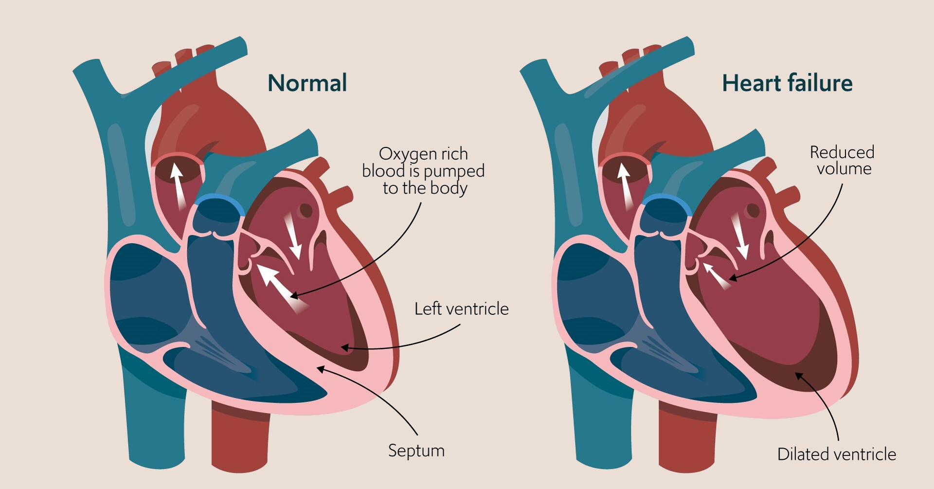 An illustration showing heart failure