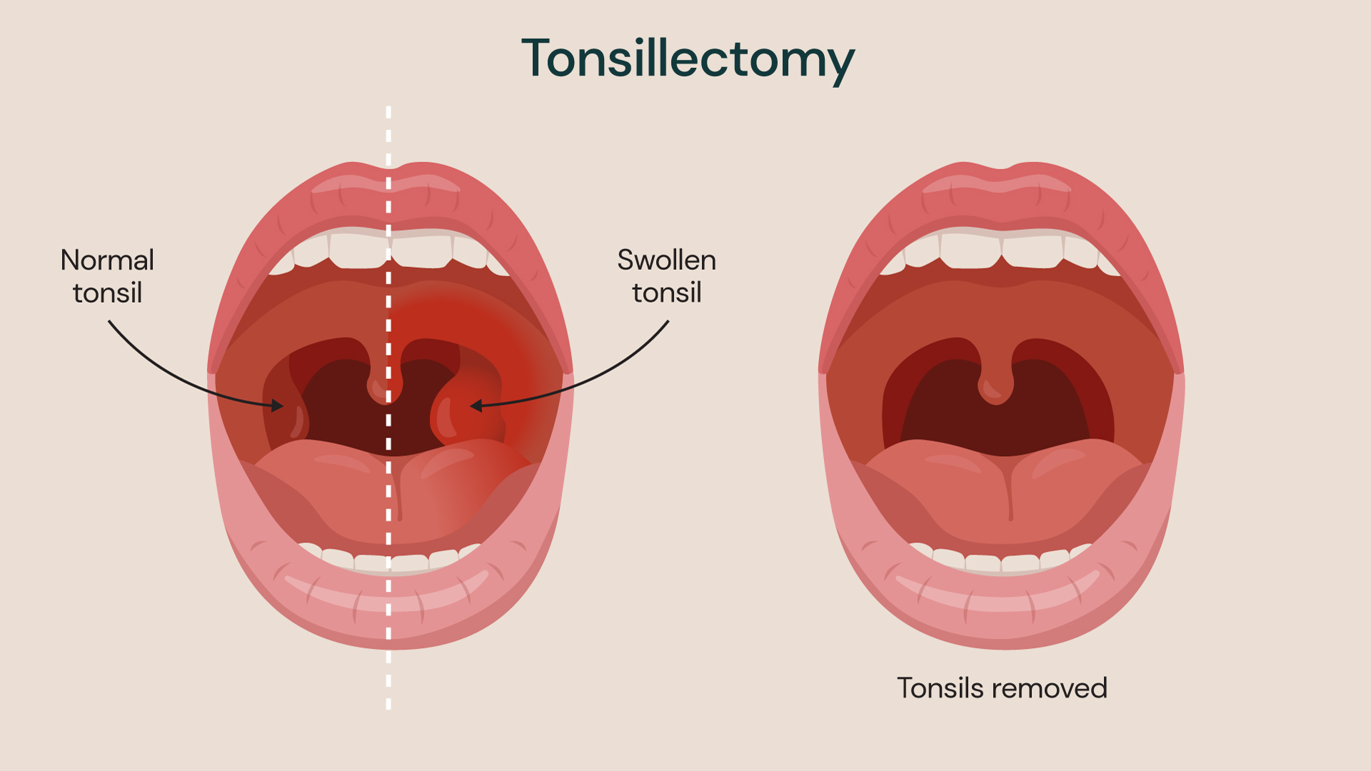 Medical illustration comparing a normal tonsil and a swollen tonsil with a post‑tonsillectomy view showing tonsils removed from the throat.
