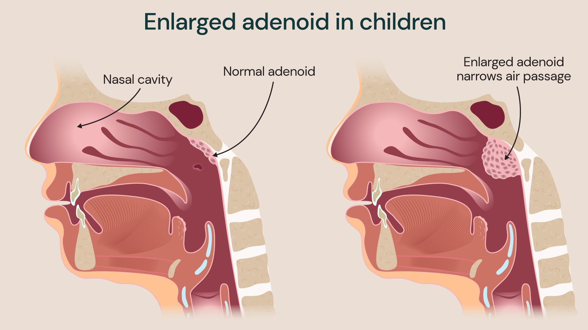 Medical illustration comparing normal adenoids and enlarged adenoids in a child, showing the nasal cavity and how enlarged adenoids narrow the airway.