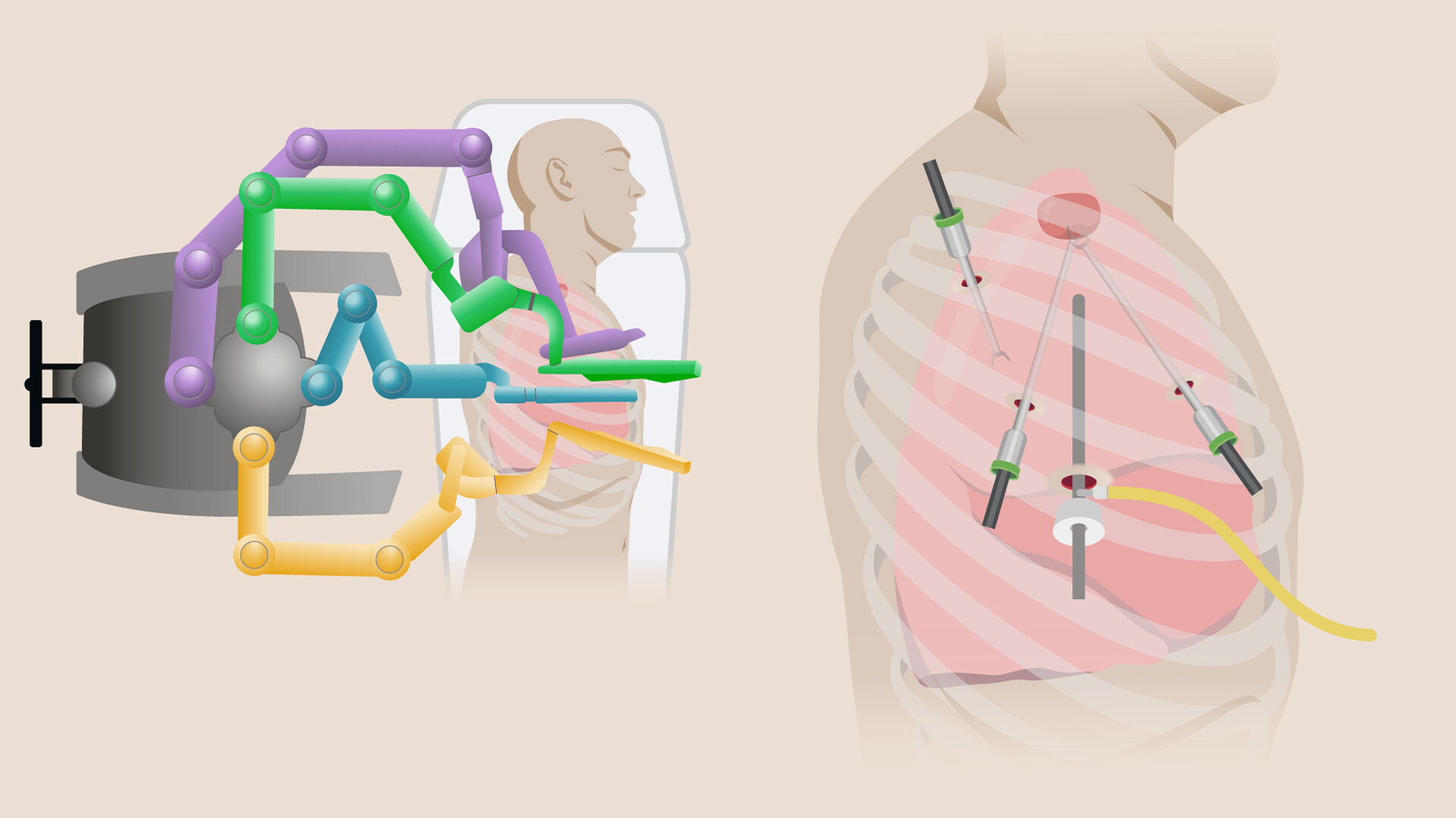 Illustration showing how robotic assisted thoracic surgery is performed