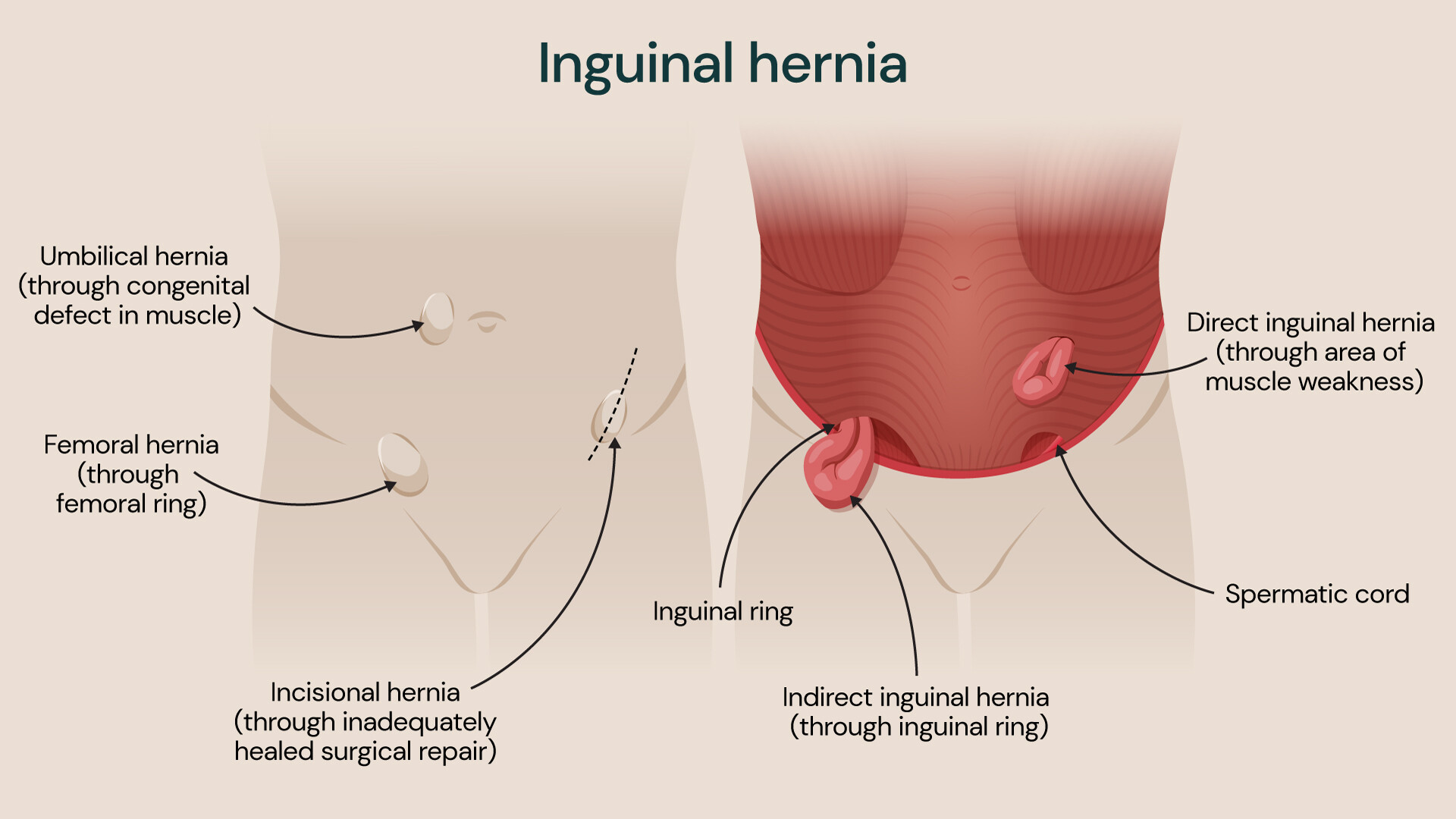 Medical illustration showing types of hernia, including indirect and direct inguinal hernia, femoral hernia, umbilical hernia and incisional hernia, with labelled inguinal ring and spermatic cord anatomy.