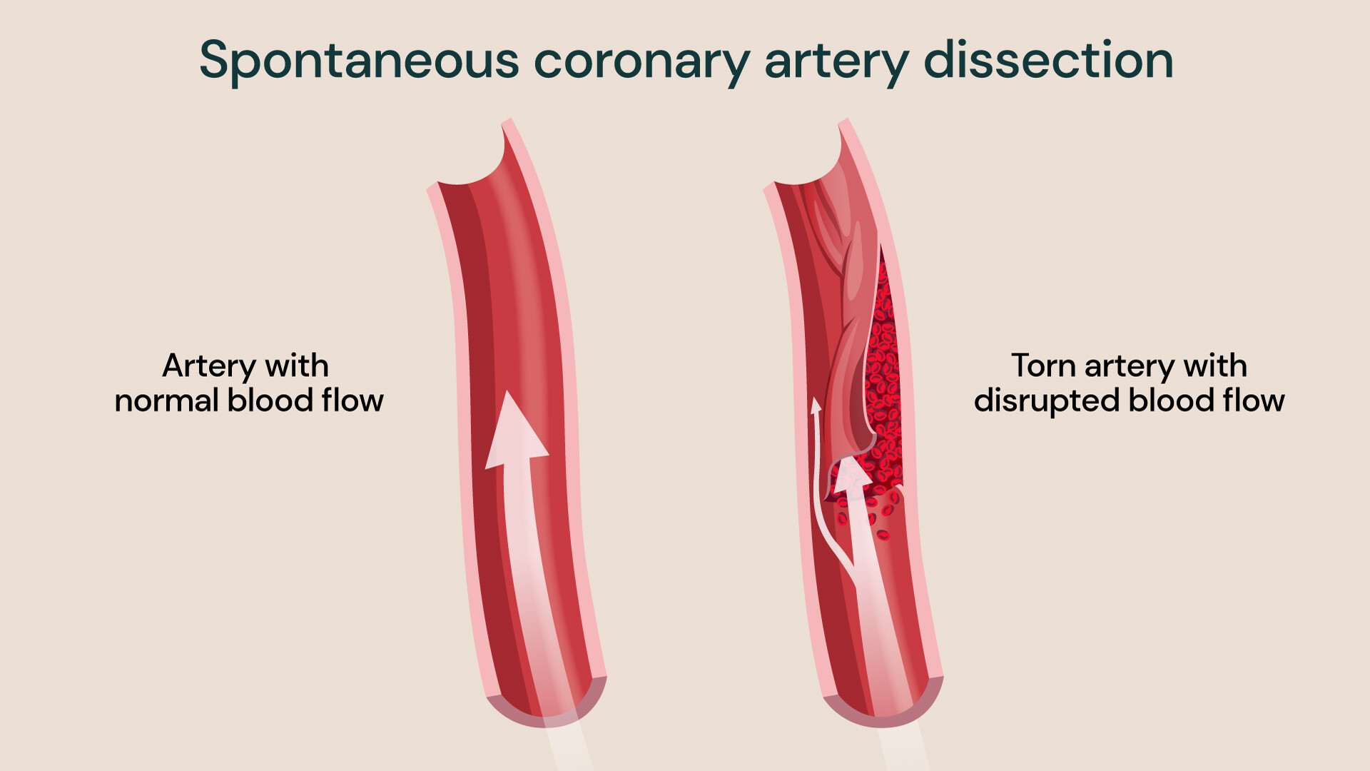 spontaneous coronary artery dissection