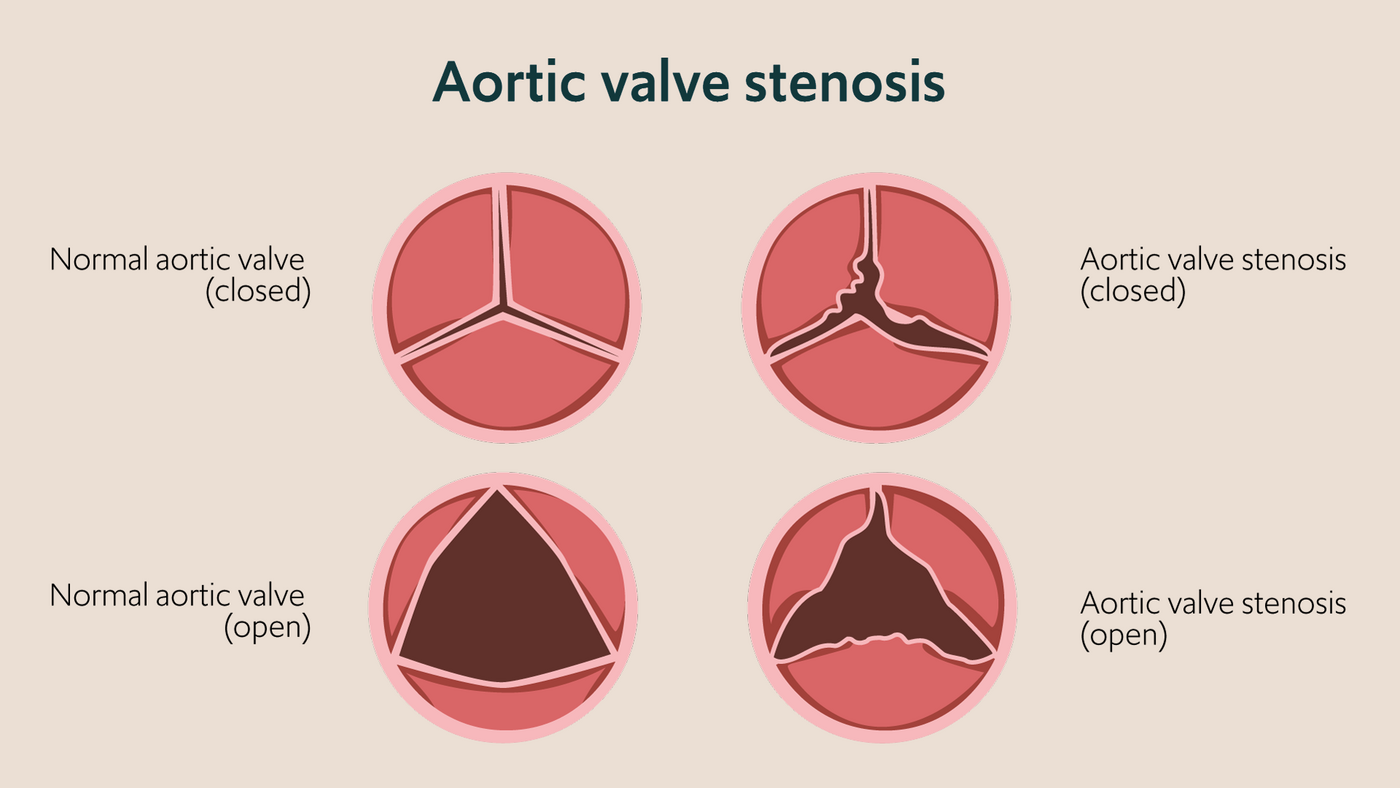 Aortic valve stenosis compared with a health valve.