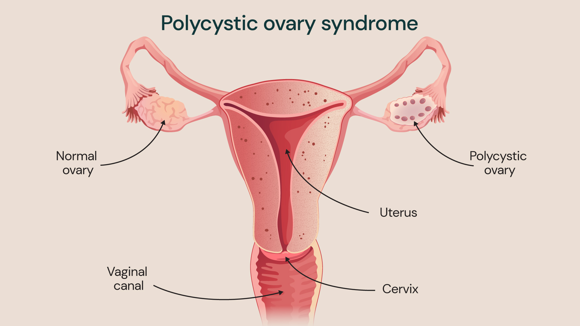 Scientific illustration showing a normal ovary compared to a polycystic ovary
